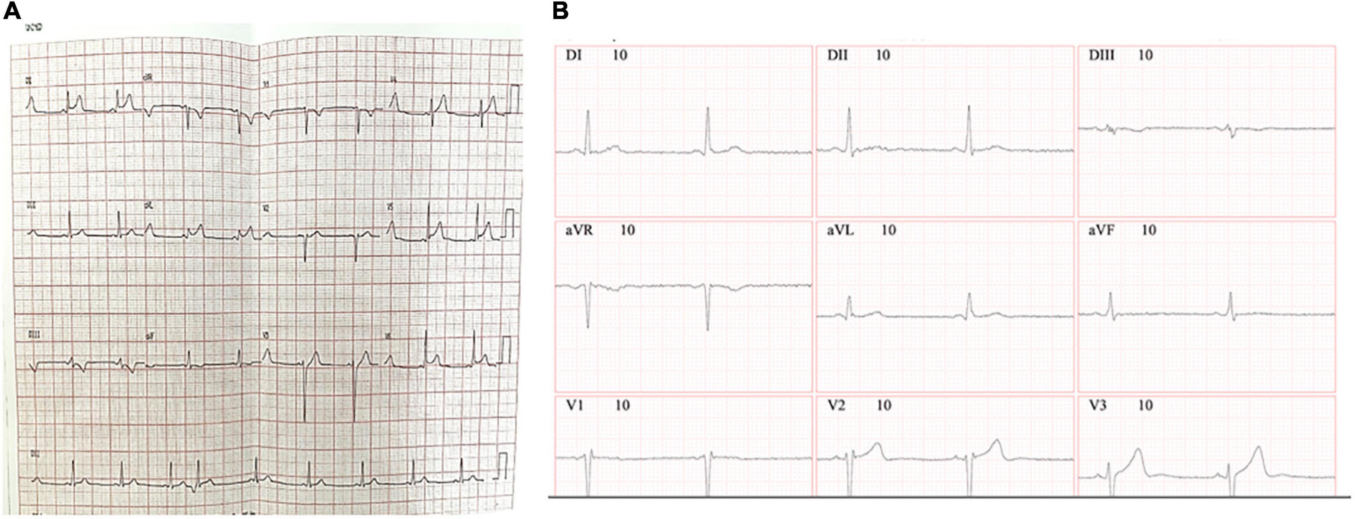 Myocardial infarction or myocarditis? A case report and review of a myocardial adverse event associated with mRNA vaccine